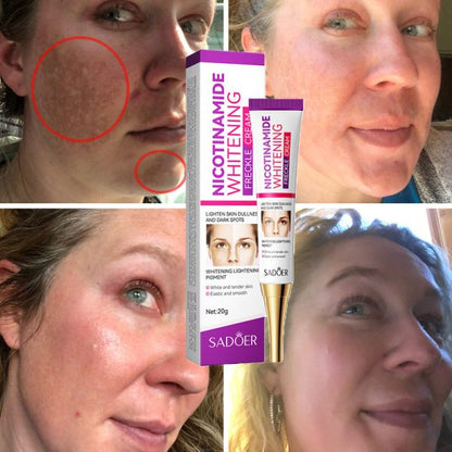 Nicotinamide Whitening Freckles Cream